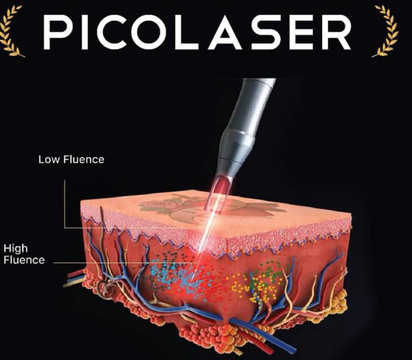 pico laserParameter Picture (1)